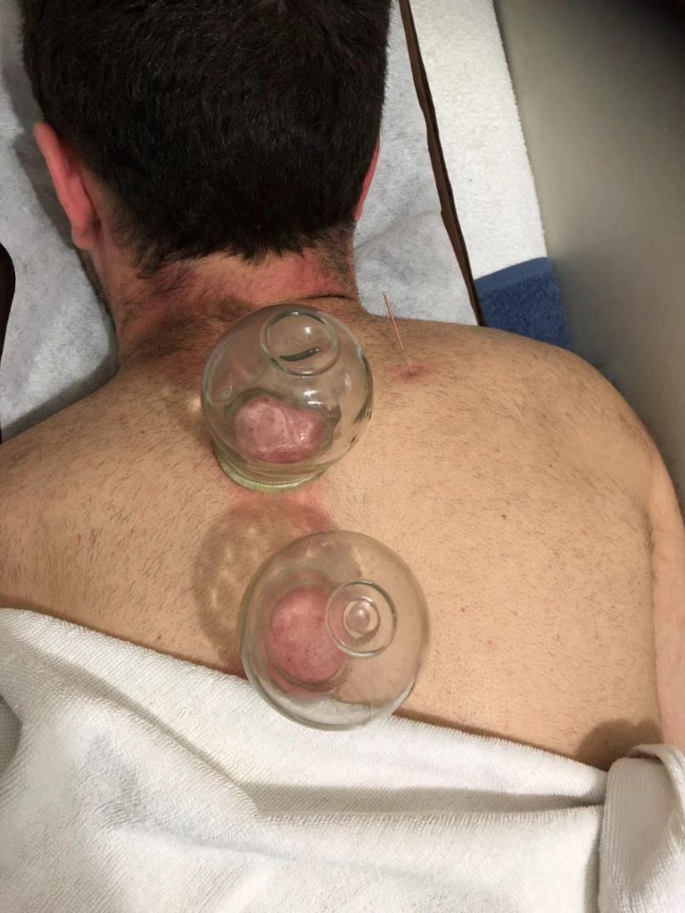 cupping in action